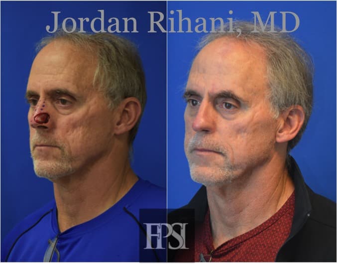 paramedian forehead flap before and after