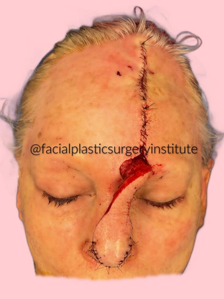 paramedian forehead flap before and after